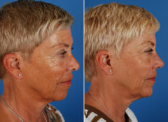 Revision Rhinoplasty Before and After Photos in Naples, FL, Patient 8619