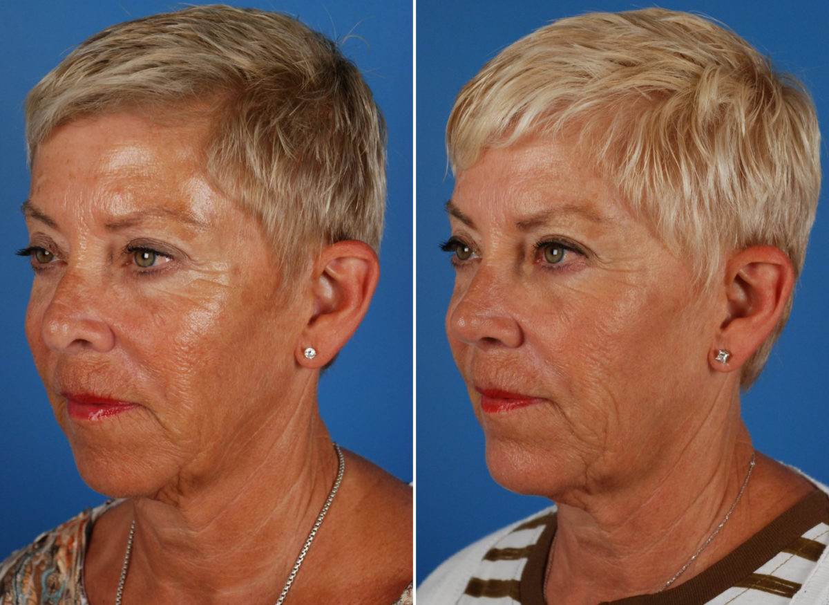 Revision Rhinoplasty Before and After Photos in Naples, FL, Patient 8619