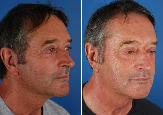 Revision Rhinoplasty Before and After Photos in Naples, FL, Patient 8628