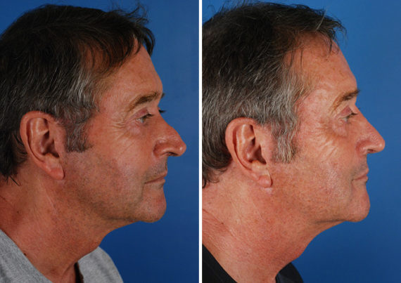 Revision Rhinoplasty Male Before and After Photos in Naples, FL, Patient 8628