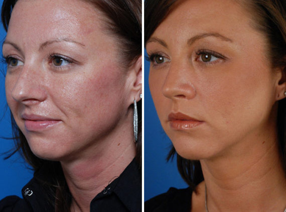 Rhinoplasty Before and After Photos in Naples, FL, Patient 8635