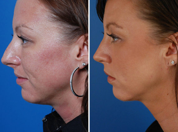 Rhinoplasty Before and After Photos in Naples, FL, Patient 8635