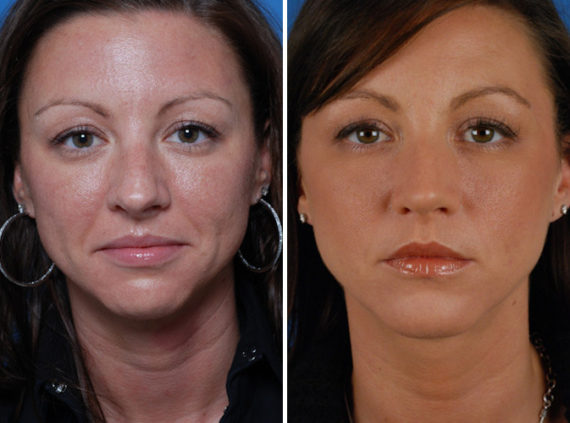 Rhinoplasty Before and After Photos in Naples, FL, Patient 8635