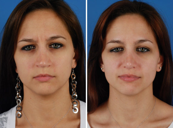 Rhinoplasty Before and After Photos in Naples, FL, Patient 8642