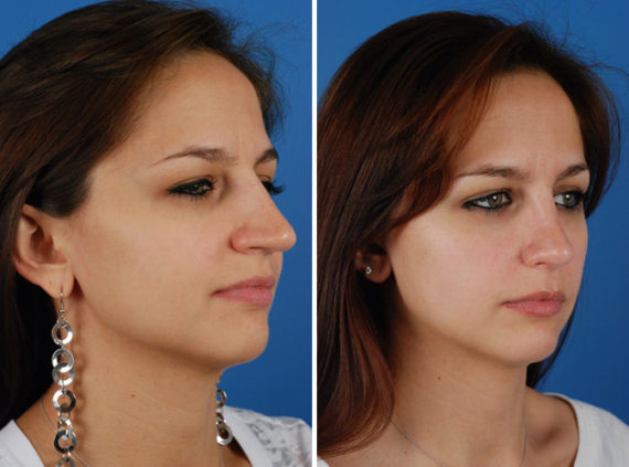 Rhinoplasty Before and After Photos in Naples, FL, Patient 8642