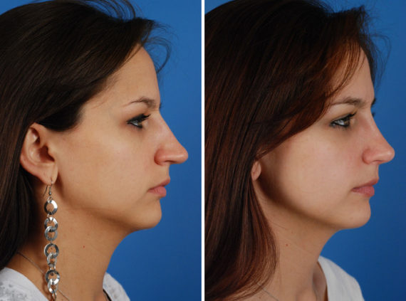 Rhinoplasty Before and After Photos in Naples, FL, Patient 8642