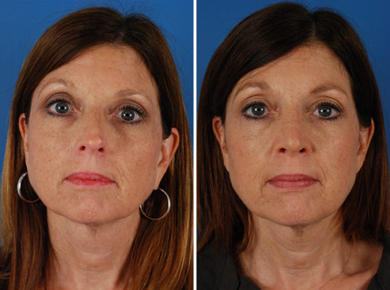 Rhinoplasty Before and After Photos in Naples, FL, Patient 8651