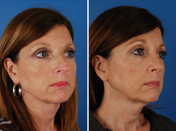 Rhinoplasty Before and After Photos in Naples, FL, Patient 8651