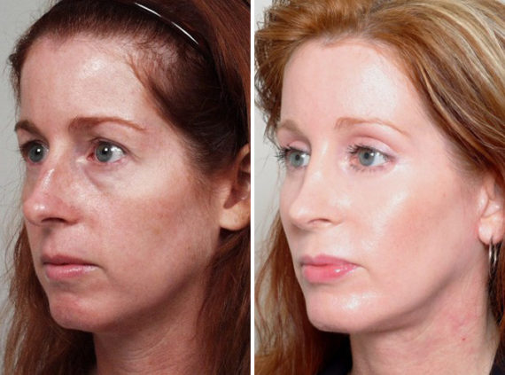 Rhinoplasty Before and After Photos in Naples, FL, Patient 8660