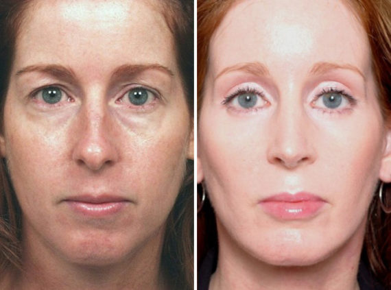 Rhinoplasty Before and After Photos in Naples, FL, Patient 8660