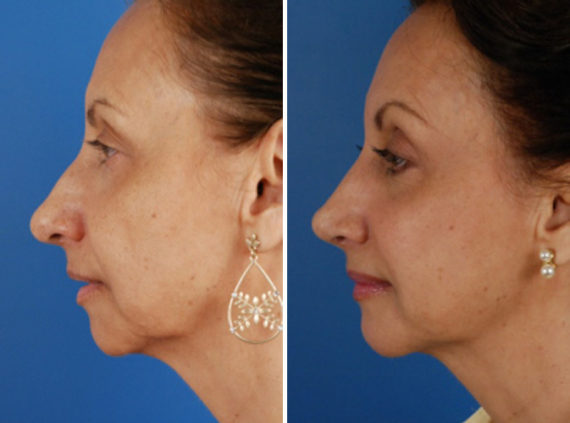 Rhinoplasty Before and After Photos in Naples, FL, Patient 8717