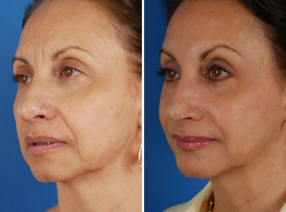 Rhinoplasty Before and After Photos in Naples, FL, Patient 8717