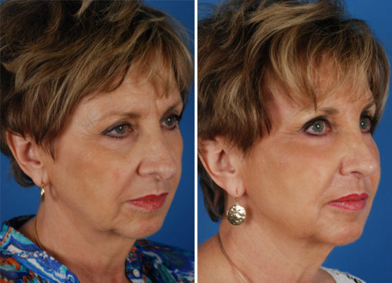 Rhinoplasty Before and After Photos in Naples, FL, Patient 8724