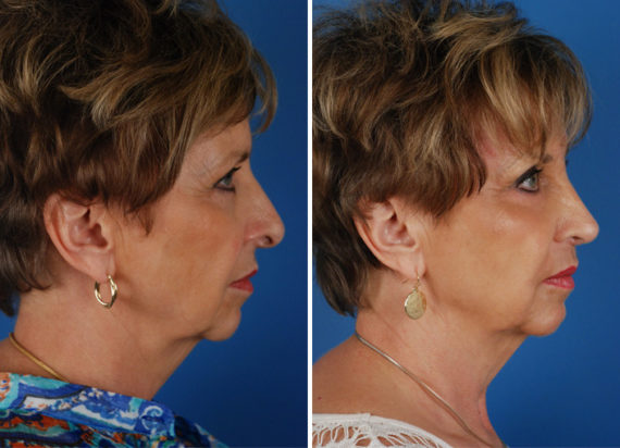 Rhinoplasty Before and After Photos in Naples, FL, Patient 8724