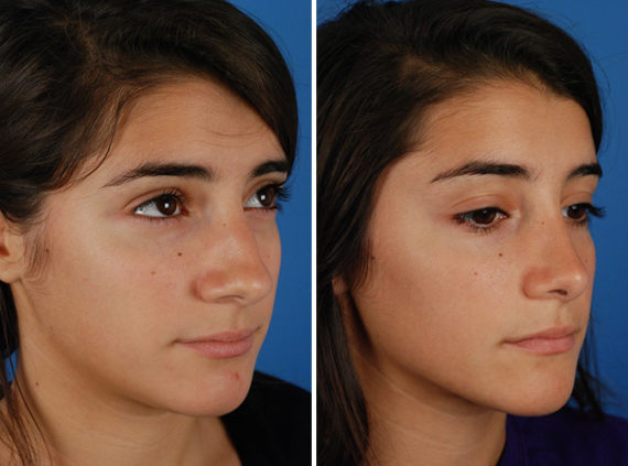 Rhinoplasty Before and After Photos in Naples, FL, Patient 8733