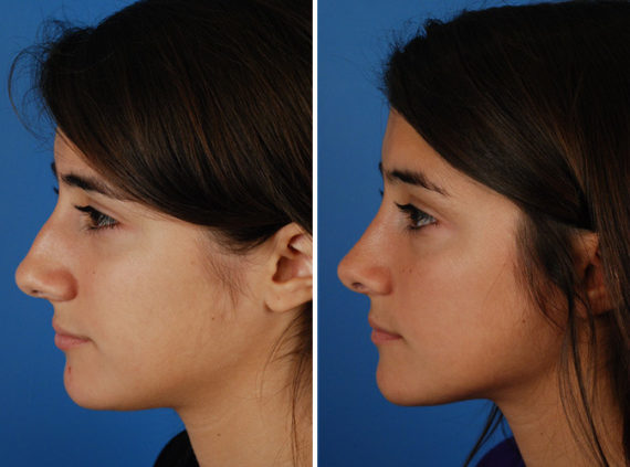 Rhinoplasty Before and After Photos in Naples, FL, Patient 8733