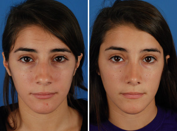 Rhinoplasty Before and After Photos in Naples, FL, Patient 8733