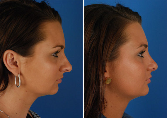 Rhinoplasty Before and After Photos in Naples, FL, Patient 8756