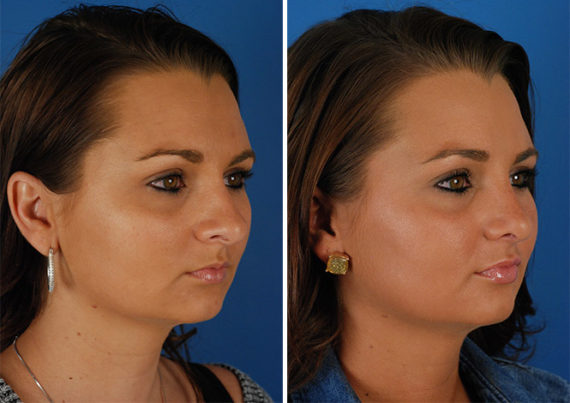 Rhinoplasty Before and After Photos in Naples, FL, Patient 8756