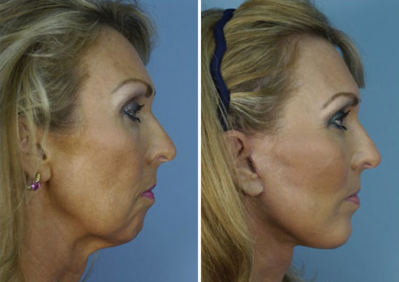 The UpLift™ Lower Face and Neck Lift Before and After Photos in Naples, FL, Patient 8761