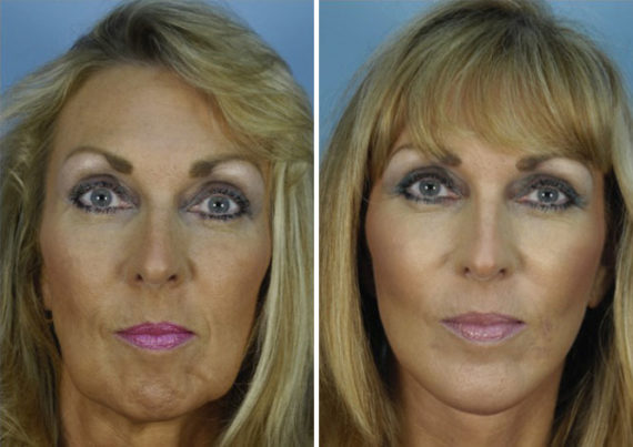 The UpLift™ Lower Face and Neck Lift Before and After Photos in Naples, FL, Patient 8761