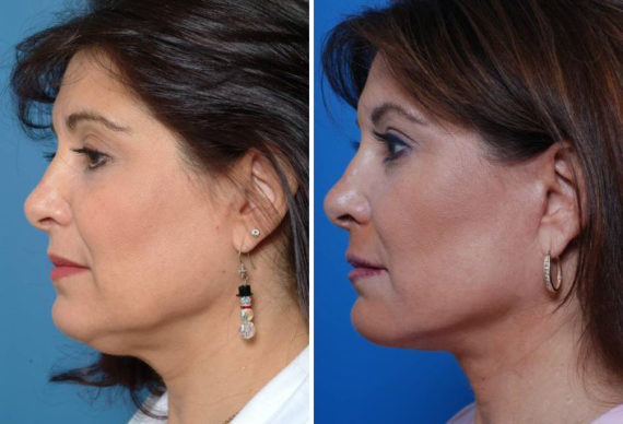 The UpLift™ Lower Face and Neck Lift Before and After Photos in Naples, FL, Patient 8782