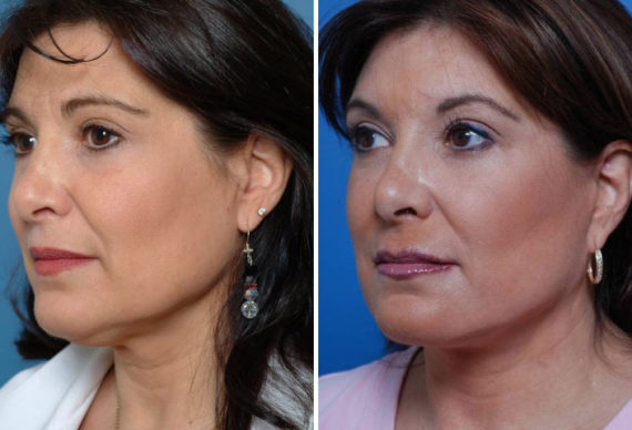 The UpLift™ Lower Face and Neck Lift Before and After Photos in Naples, FL, Patient 8782