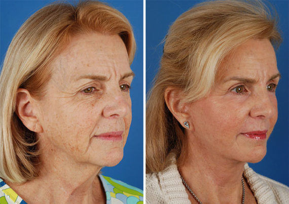 The UpLift™ Lower Face and Neck Lift Before and After Photos in Naples, FL, Patient 8808