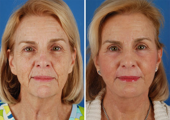 The UpLift™ Lower Face and Neck Lift Before and After Photos in Naples, FL, Patient 8808