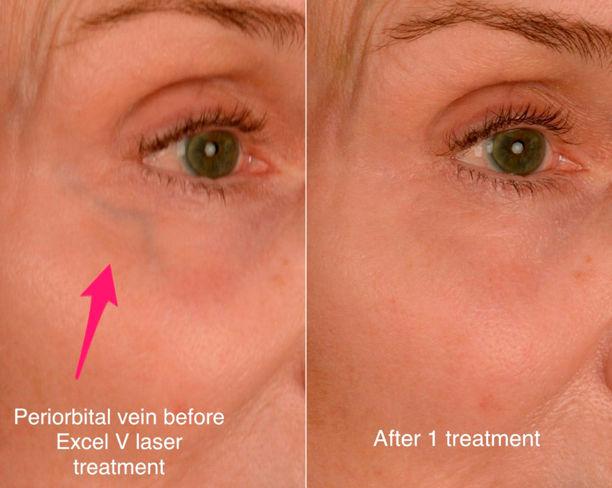 Cutera Excel V Laser Before and After Photos in Naples, FL, Patient 18768