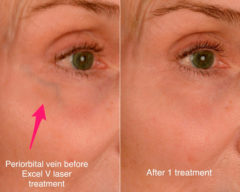 Cutera Excel V Laser Before and After Photos in Naples, FL, Patient 18768