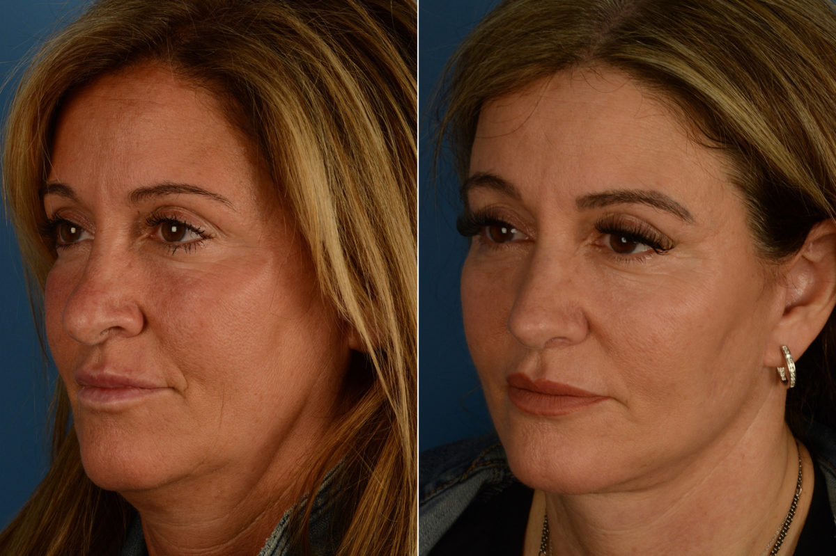Rhinoplasty Before and After Photos in Naples, FL, Patient 18779