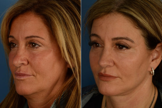 Rhinoplasty Before and After Photos in Naples, FL, Patient 18779
