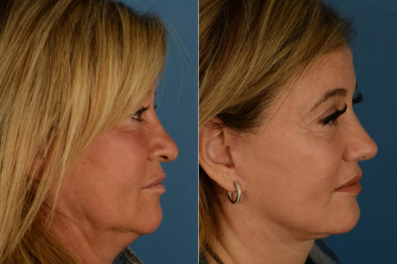 Rhinoplasty Before and After Photos in Naples, FL, Patient 18779