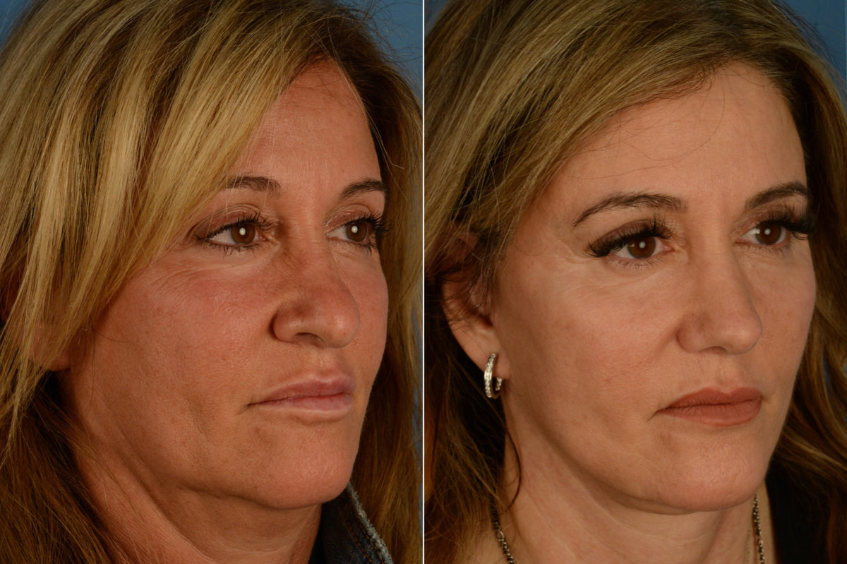 Rhinoplasty Before and After Photos in Naples, FL, Patient 18779