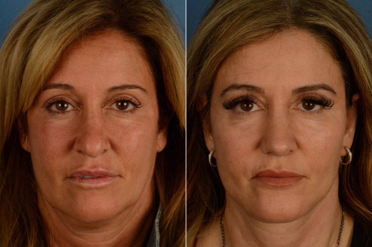 Rhinoplasty Before and After Photos in Naples, FL, Patient 18779