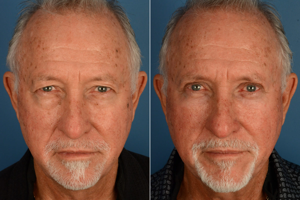 Blepharoplasty Before and After Photos in Naples, FL, Patient 18812