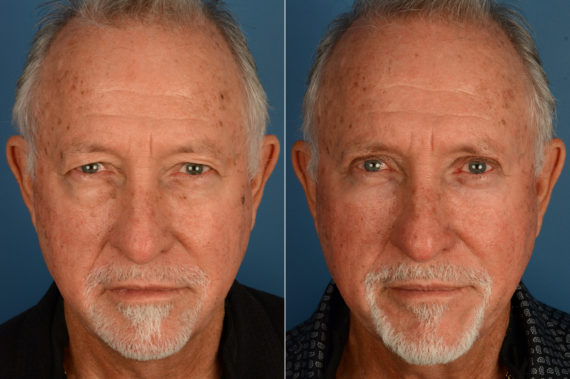 Blepharoplasty Before and After Photos in Naples, FL, Patient 18812