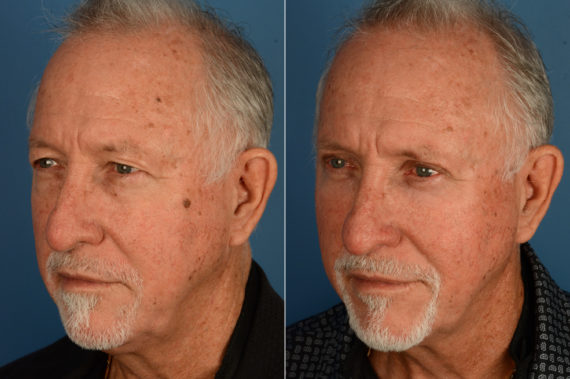 Blepharoplasty Before and After Photos in Naples, FL, Patient 18812
