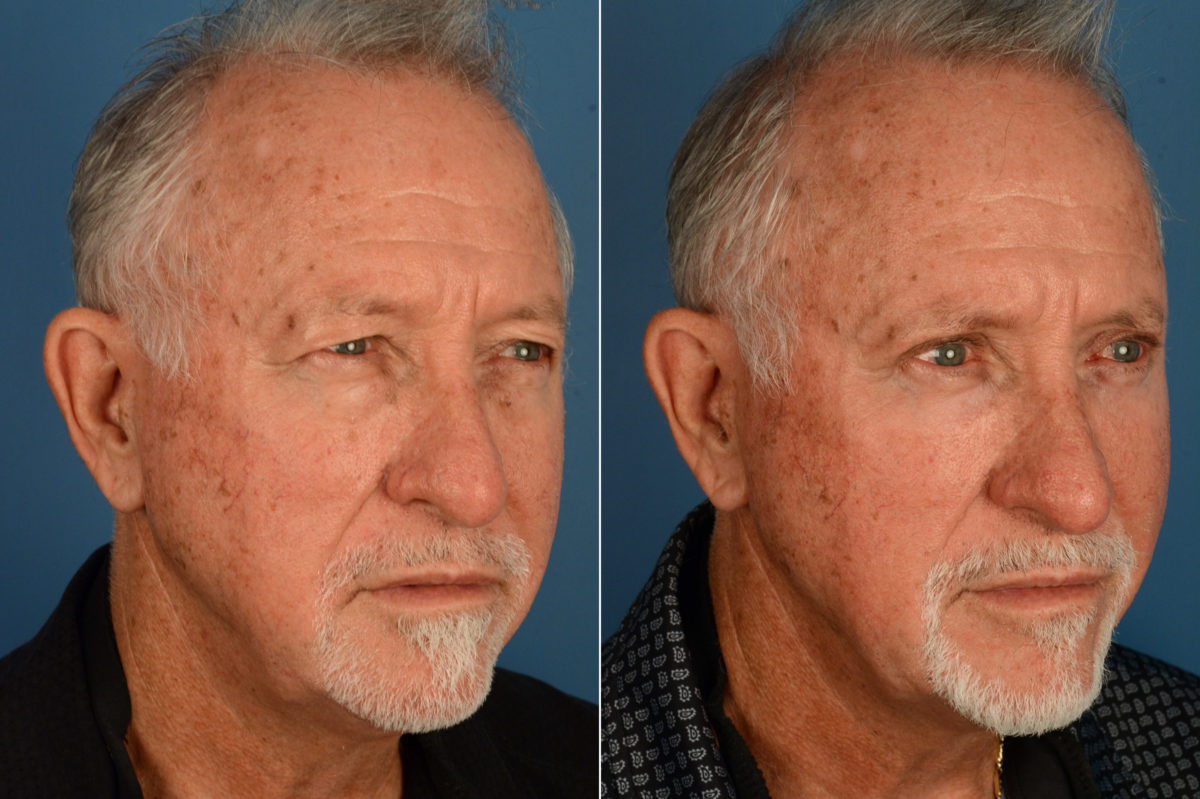 Blepharoplasty Before and After Photos in Naples, FL, Patient 18812