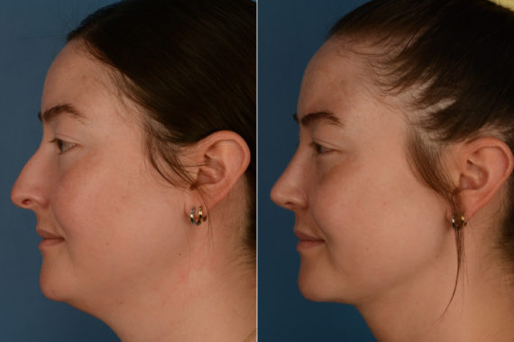 Rhinoplasty Before and After Photos in Naples, FL, Patient 18825