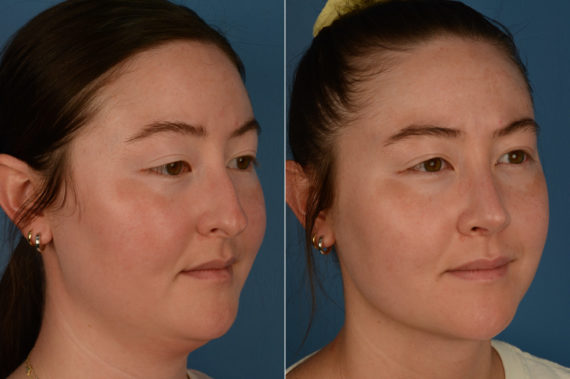 Rhinoplasty Before and After Photos in Naples, FL, Patient 18825