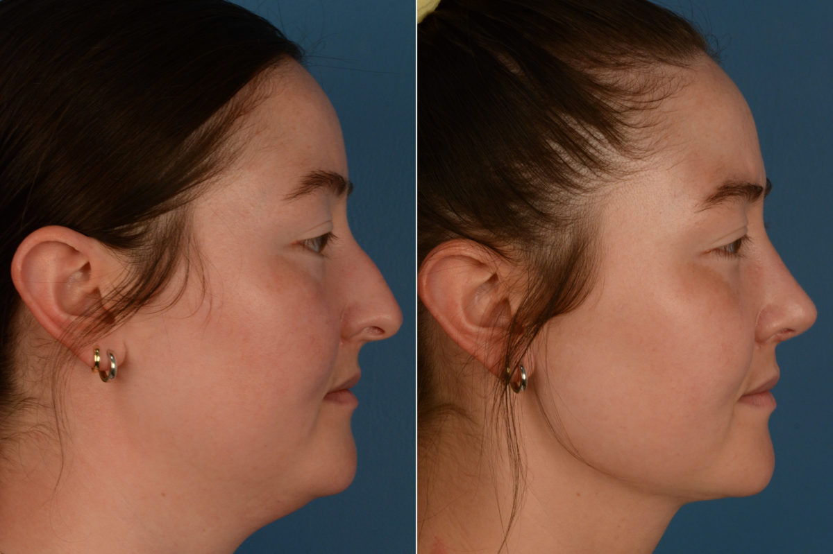 Rhinoplasty Before and After Photos in Naples, FL, Patient 18825