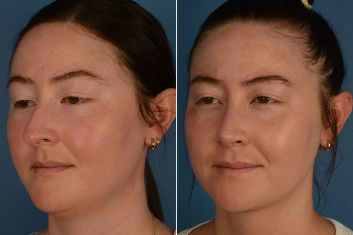 Rhinoplasty Before and After Photos in Naples, FL, Patient 18825