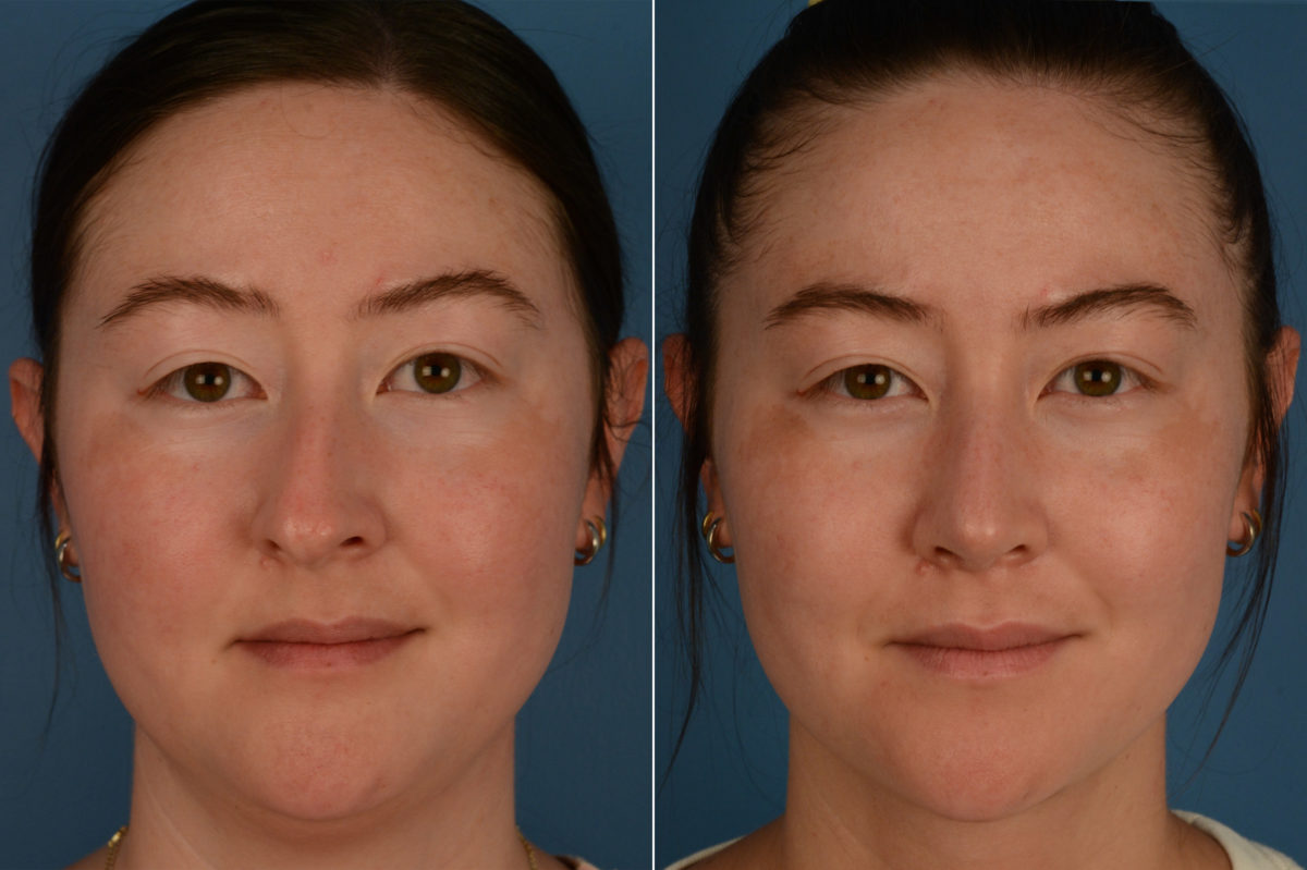 Rhinoplasty Before and After Photos in Naples, FL, Patient 18825