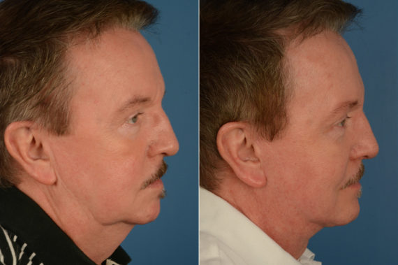 The UpLift™ Lower Face and Neck Lift Before and After Photos in Naples, FL, Patient 18924
