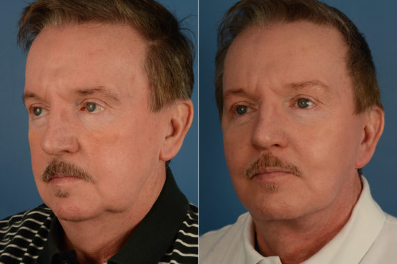 The UpLift™ Lower Face and Neck Lift Before and After Photos in Naples, FL, Patient 18924