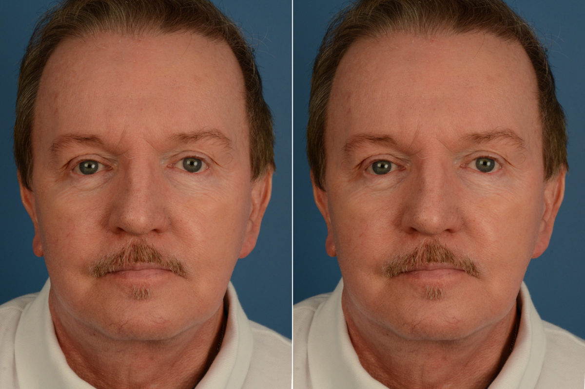 The UpLift™ Lower Face and Neck Lift Before and After Photos in Naples, FL, Patient 18924