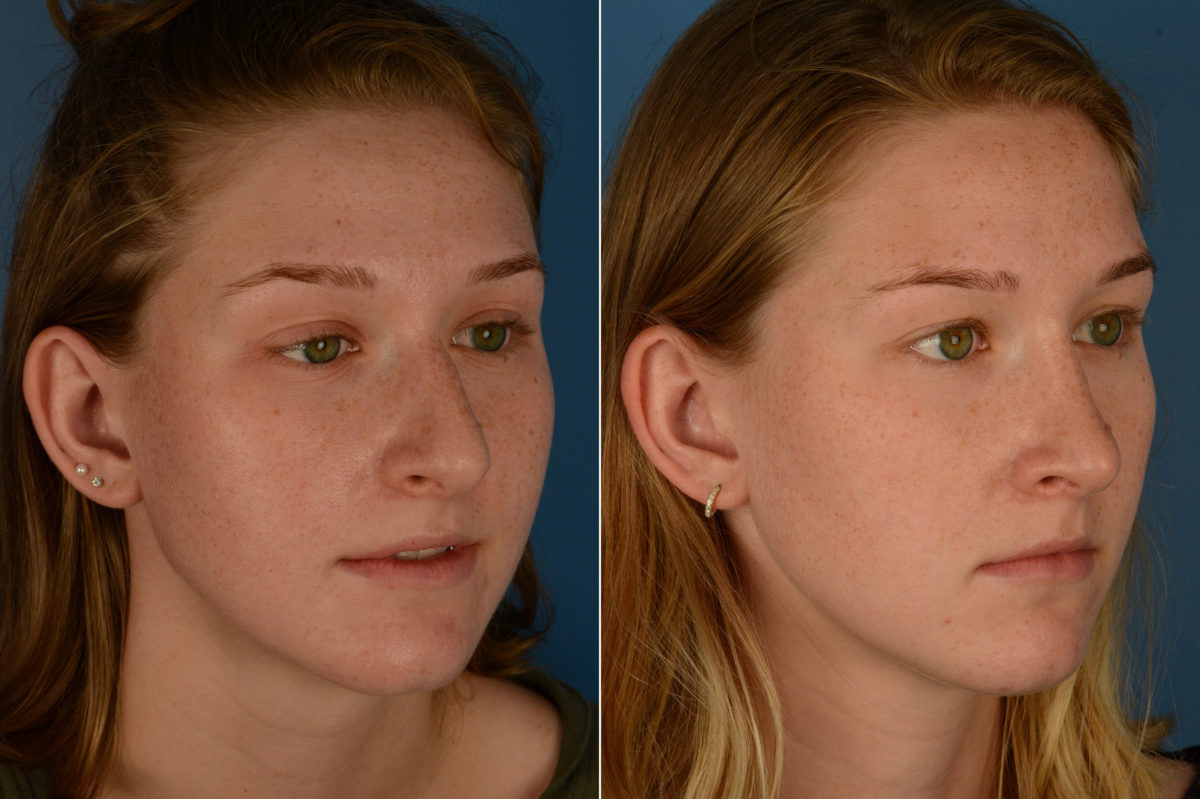 Rhinoplasty Before and After Photos in Naples, FL, Patient 18974
