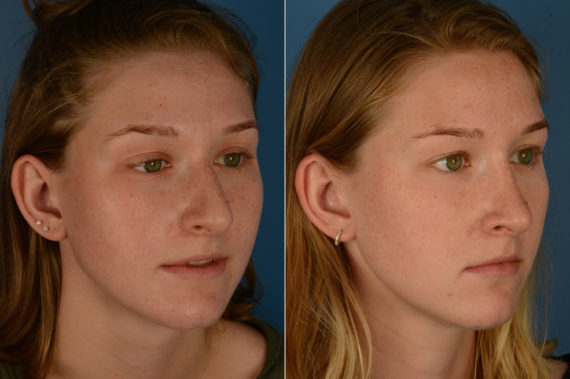 Rhinoplasty Before and After Photos in Naples, FL, Patient 18974